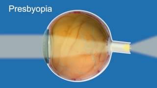 Presbyopia