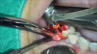 Drilling Procedure with MSDI implants