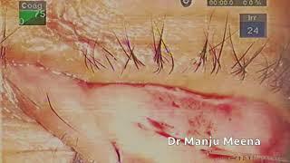 Cicatricial entropion of upper eyelid