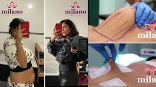 Which regions is the LIPOSUCTION SURGERY Performed on?- Milano Clinic Turkey