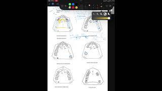 Design of RPD of upper denture