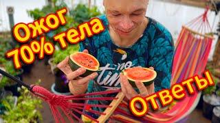  Ожог 70% Тела || Моя История и Ответы На Ваши Вопросы ️