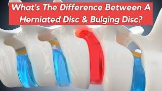 What Is The Difference Between A Herniated Disc and Bulging Disc?