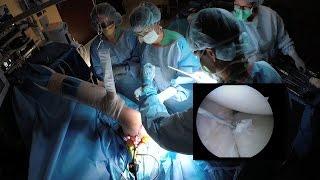 Arthroscopic Shoulder Dislocation Surgery