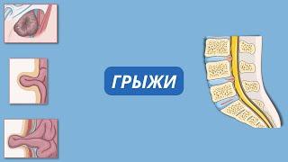 что такое грыжа? виды и лечение