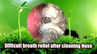 Difficult breath relief after cleaning nose