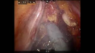 AUA Teaching Videos: Nerve-sparing technique during robotic radical cystoprostatectomy