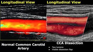 Carotid Artery Color/Spectral Doppler Ultrasound Normal Vs Abnormal Images | ICA Stenosis USG