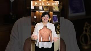 How to get rid of Back Acne? | Back Acne Treatment | Lacne Body Spray #shorts