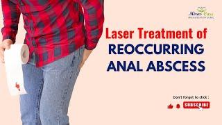 Laser treatment of reoccurring anal abscess | Anal abscess Surgery in Gurgaon | Mirascare