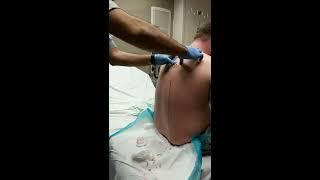 Large cyst Bursts out mans back! Viewer beware