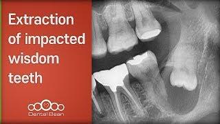 Extraction of impacted wisdom teeth- [Dr. Cho Yongseok]
