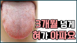 구강작열감증후군/ 원인 모를 혀통증 입안 따끔거림이 3개월 넘게 계속된다면?