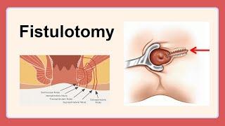 fistulotomy