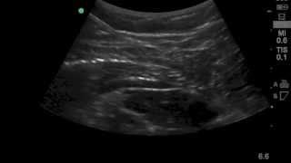 Case of the Week: Quadratus Lumborum (QL) Catheter