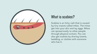 Scabies: Signs, Symptoms, Causes, and Treatment | Merck Manual Consumer Version