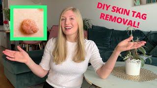 DIY Skin Tag Remover REVIEW!