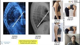 ΑΣΚΗΣΕΙΣ ΓΙΑ ΚΥΦΩΣΗ - PHYSIOTHERAPEUTIC SPECIFIC EXERCISES FOR SCHEUERMANN KYPHOSIS