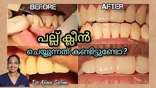 പല്ല് ക്ലീൻ ചെയ്യുന്നത്  കണ്ടിട്ടുണ്ടോ | Scaling of Teeth by Dr Ajina Salim | Dr Ajina Salim