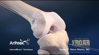 Steve Martin, MD, Explains ACL Reconstruction using InternalBrace™ Technique on The ROAR FM