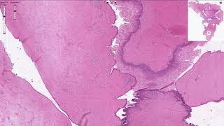 Bartholin Gland Cyst - Vulva, Histopathology