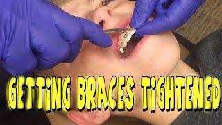 GETTING BRACES TIGHTENED FOR THE FIRST TIME