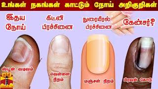 உங்கள் நகங்கள் காட்டும் நோய் அறிகுறிகள் | Nail disease