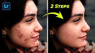 How to Remove ACNE in Lightroom | In 90 Seconds