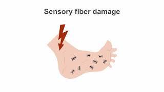 Diabetic Neuropathy: Advanced Management Techniques