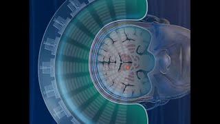 Focused Ultrasound Treatment for Essential Tremor - UNC Neurosurgery