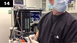 Timed tracheal intubation with video laryngoscope