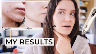 How to Get Rid of Skin Tags Moles Warts | PLASMA IQ vs PLASMA MOLE SKIN TAG REMOVAL PEN REVIEW DEMO