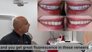 Full mouth non cutting veneers By Dr Aleem