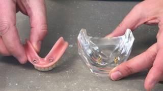 Removable lower dentures on two implants
