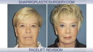 Facelift Revision Surgery