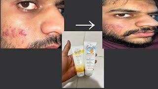 Episoft spf 30 suscreen review|Episoft spf 50|Sunscreen for winter acne prone skin|