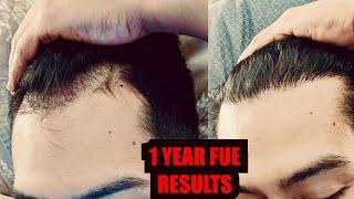 Mexican Hair Transplant after 1 Year! HMR Tijuana: Dr Cortez