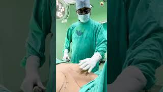 Vaser Liposuction in Gynecomastia Surgery | Dr. Ritesh Anand #shorts #shortsfeed