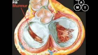 Animated Mitral Stenosis Murmur