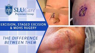 The Difference Between Excision, Staged Excision & Mohs Surgery for removing skin cancer