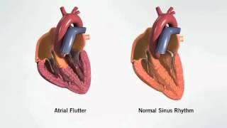 Atrial Flutter