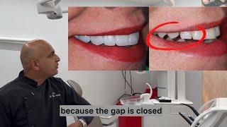 Upper smile transformation with non cutting porcelain veneers By Dr Aleem