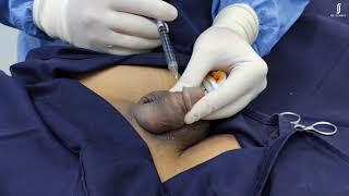 Non-surgical Penile Enlargement #penilefiller #biggerpenis #penisfiller
