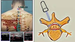 Thoracic Epidural US Assisted  POCUS MOSCOW Approach УЗИ ассистированный грудной эпидуральный блок