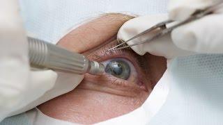Незрелая катаракта глаза - лечение без операции и хирургическое