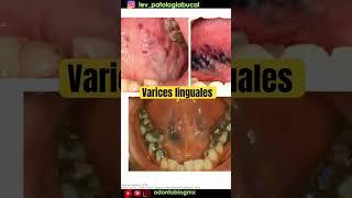 Várices linguales #shorts #varices #várices #variceslinguales #váriceslinguales #odontoblogmx