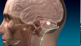 Deep Brain Stimulation for Stroke Recovery Animation