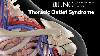 Thoracic Outlet Syndrome