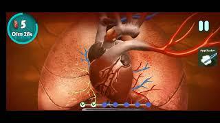 Ascending Aortic Aneurysm Surgery //Dr Najid  #heartsurgery