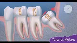 Tema 5: Cirugía Oral: Terceros Molares.